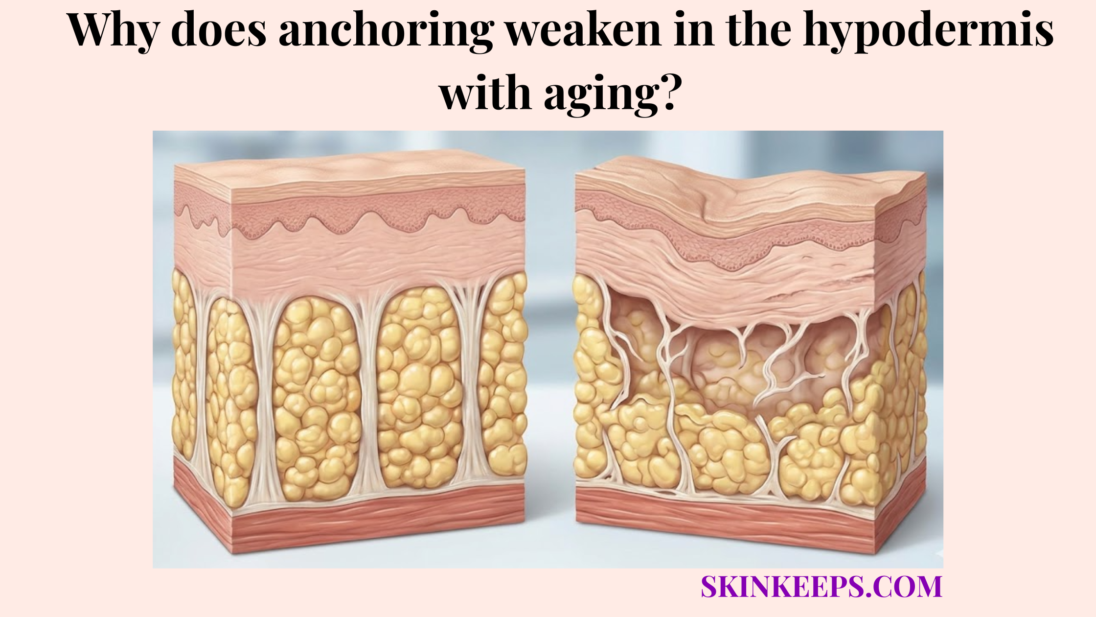 anchoring weaken in the hypodermis with aging