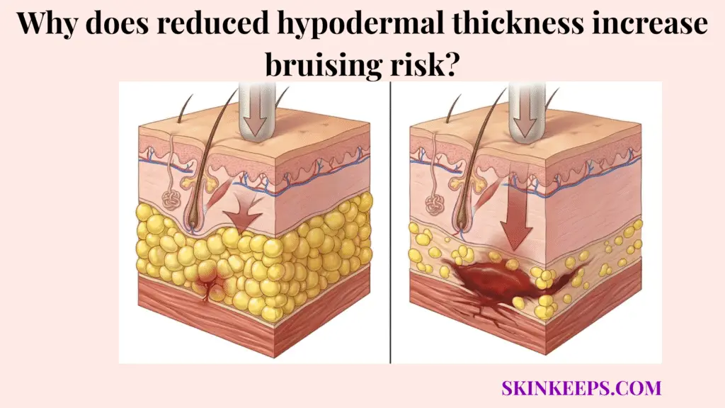 reduced hypodermal thickness increase bruising risk
