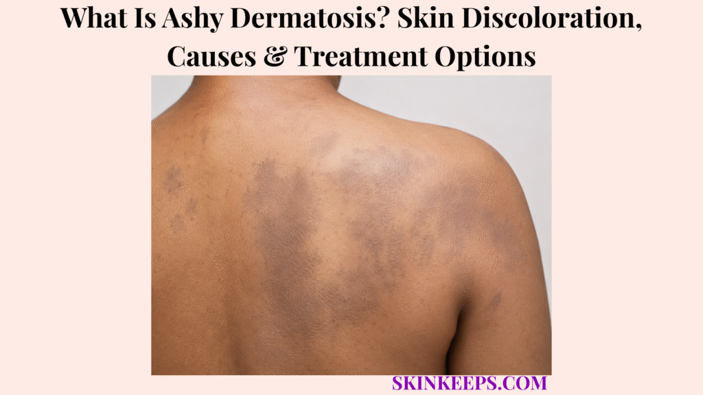 What Is Ashy Dermatosis? Skin Discoloration, Causes & Treatment Options