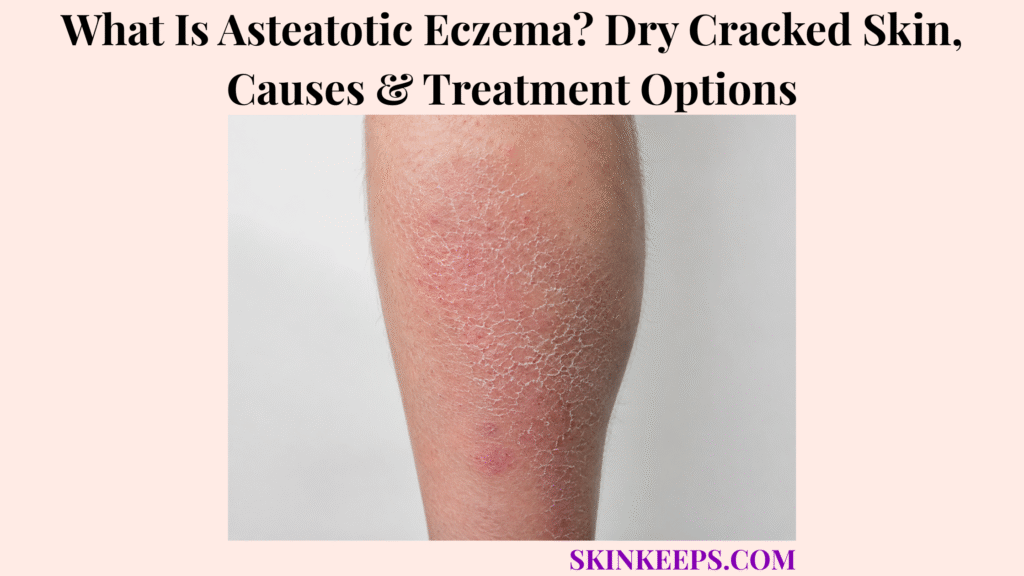 What Is Asteatotic Eczema? Dry Cracked Skin, Causes & Treatment Options