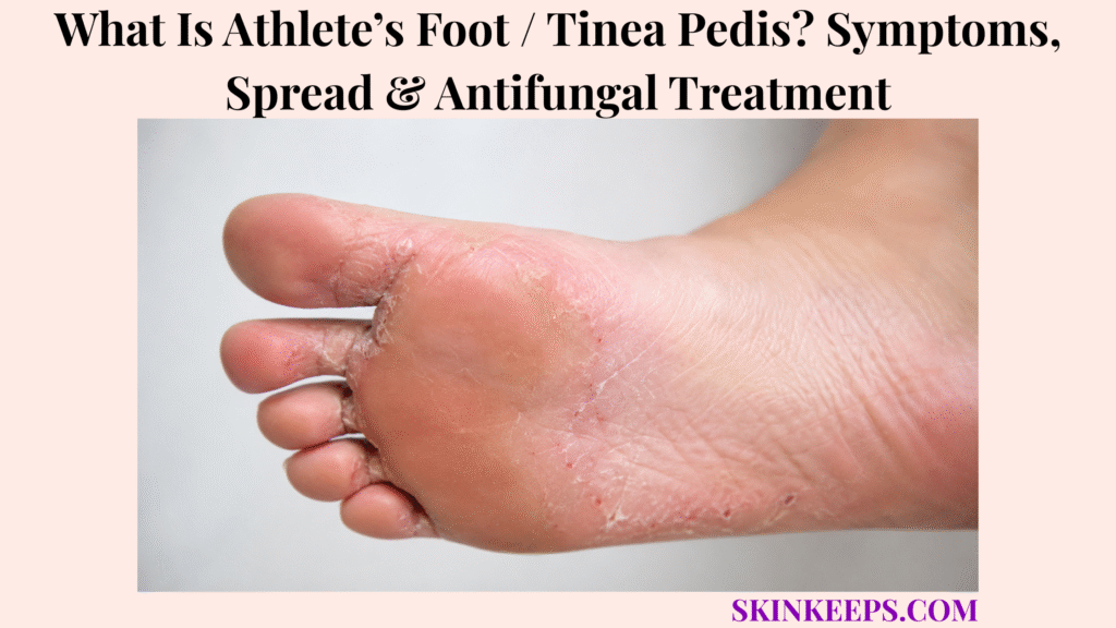 Realistic close-up of athlete’s foot showing dry, peeling, cracked, and mildly red skin across the sole and between the toes.