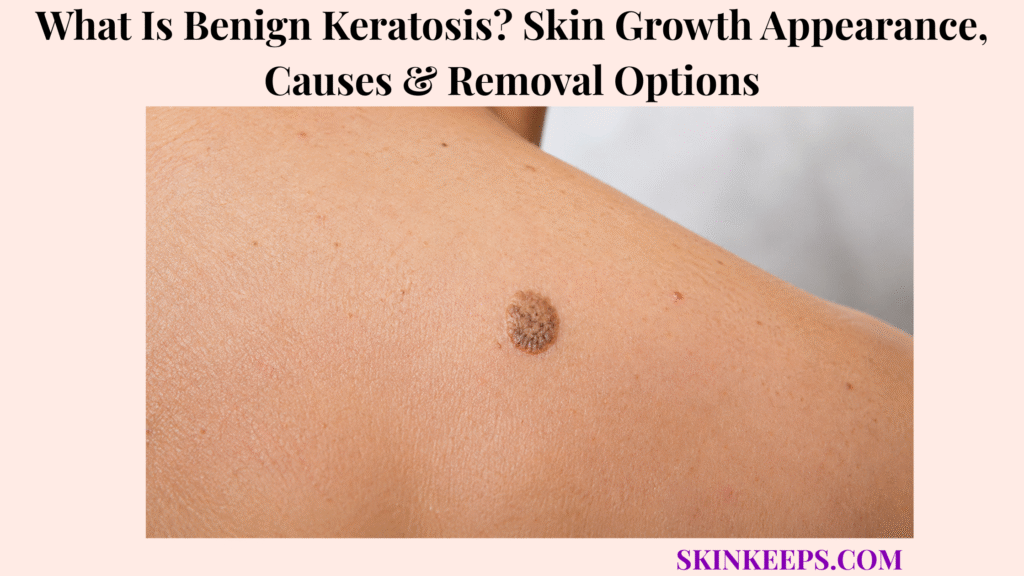 Realistic close-up of benign keratosis showing a raised, well-defined brown skin growth with a rough, waxy surface.
