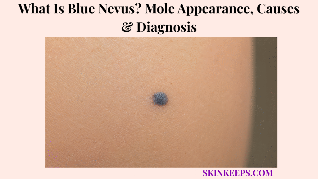 Realistic close-up of a blue nevus showing a small, round, well-defined blue-gray mole on otherwise healthy skin.