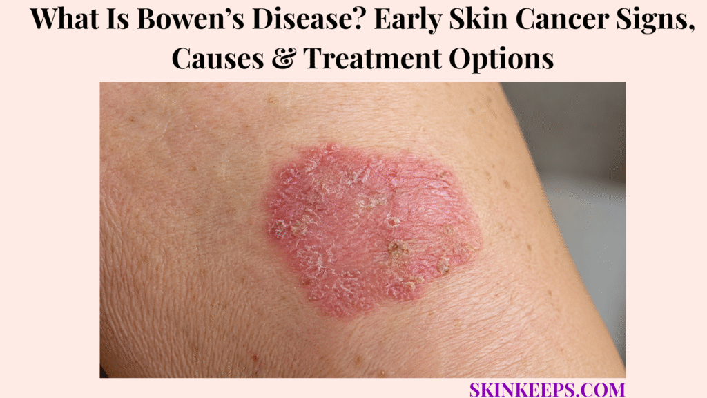 Realistic close-up of Bowen’s disease showing a well-defined red, dry, scaly skin patch with mild crusting.
