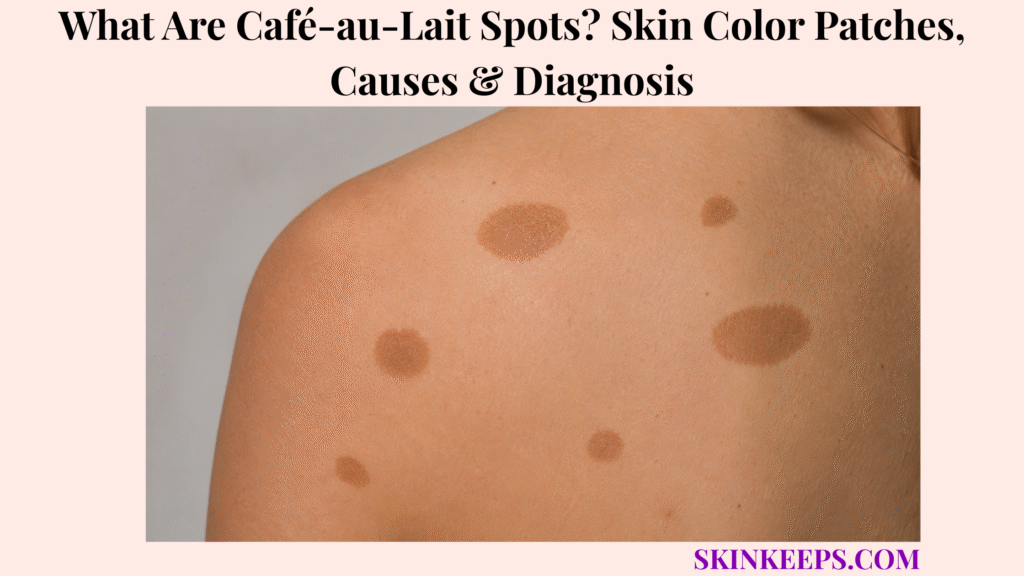 Realistic close-up of multiple café-au-lait spots showing flat, smooth, light-brown patches on the shoulder and upper back.