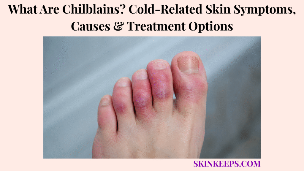 What Are Chilblains? Cold-Related Skin Symptoms, Causes & Treatment Options