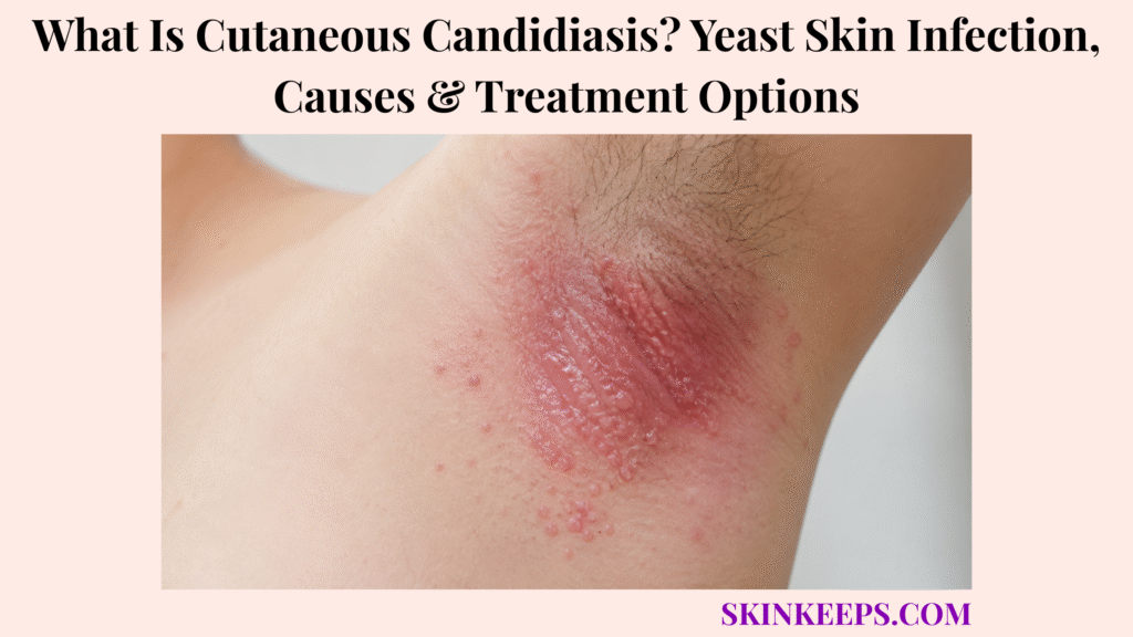 What Is Cutaneous Candidiasis? Yeast Skin Infection, Causes & Treatment Options