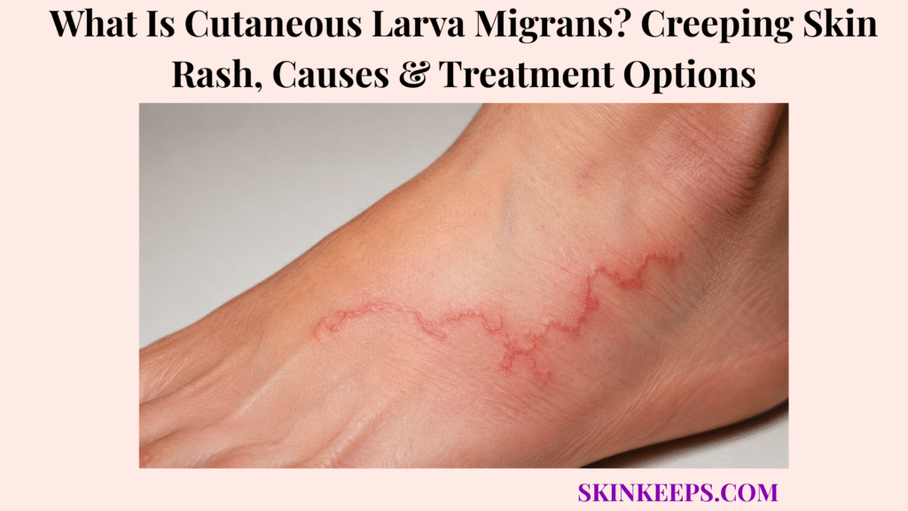 What Is Cutaneous Larva Migrans? Creeping Skin Rash, Causes & Treatment Options