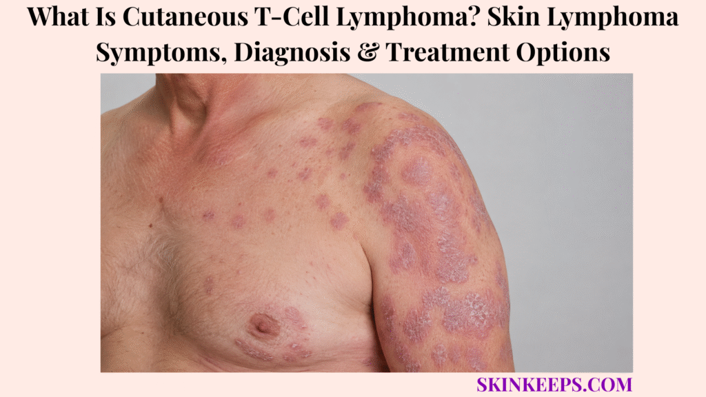 What Is Cutaneous T-Cell Lymphoma? Skin Lymphoma Symptoms, Diagnosis & Treatment Options