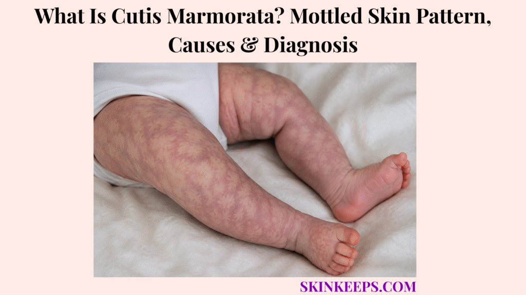 What Is Cutis Marmorata? Mottled Skin Pattern, Causes & Diagnosis