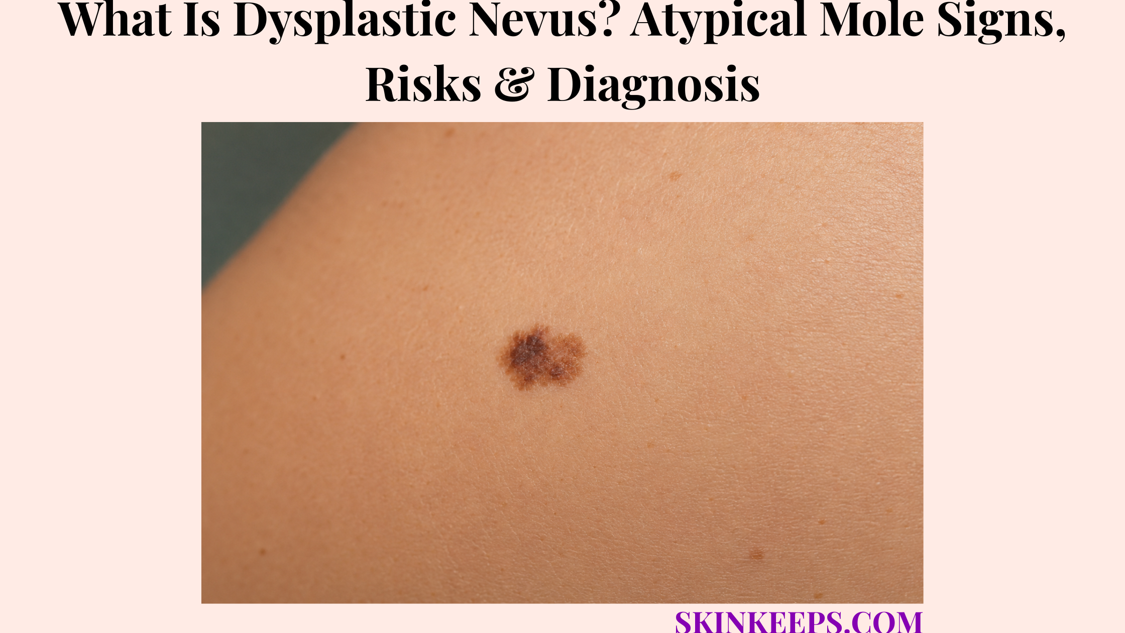 What Is Dysplastic Nevus? Atypical Mole Signs, Risks & Diagnosis