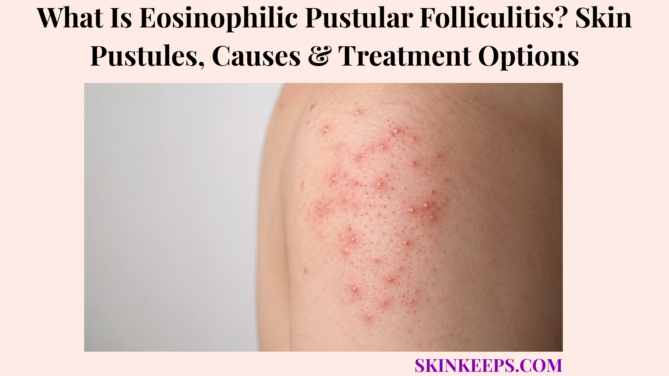 What Is Eosinophilic Pustular Folliculitis? Skin Pustules, Causes & Treatment Options