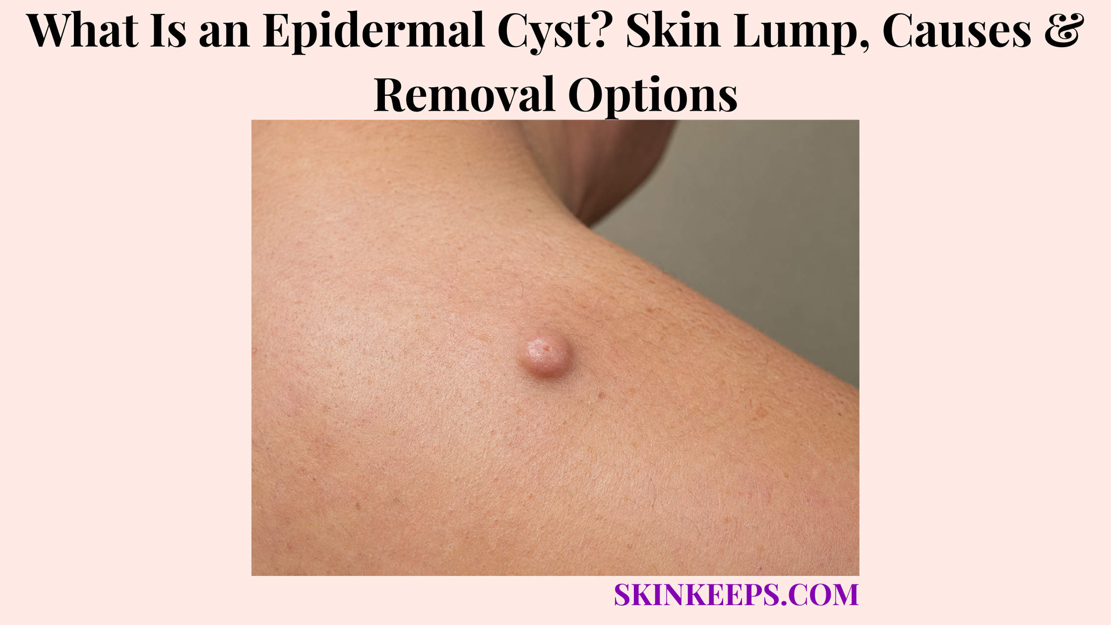 What Is an Epidermal Cyst? Skin Lump, Causes & Removal Options