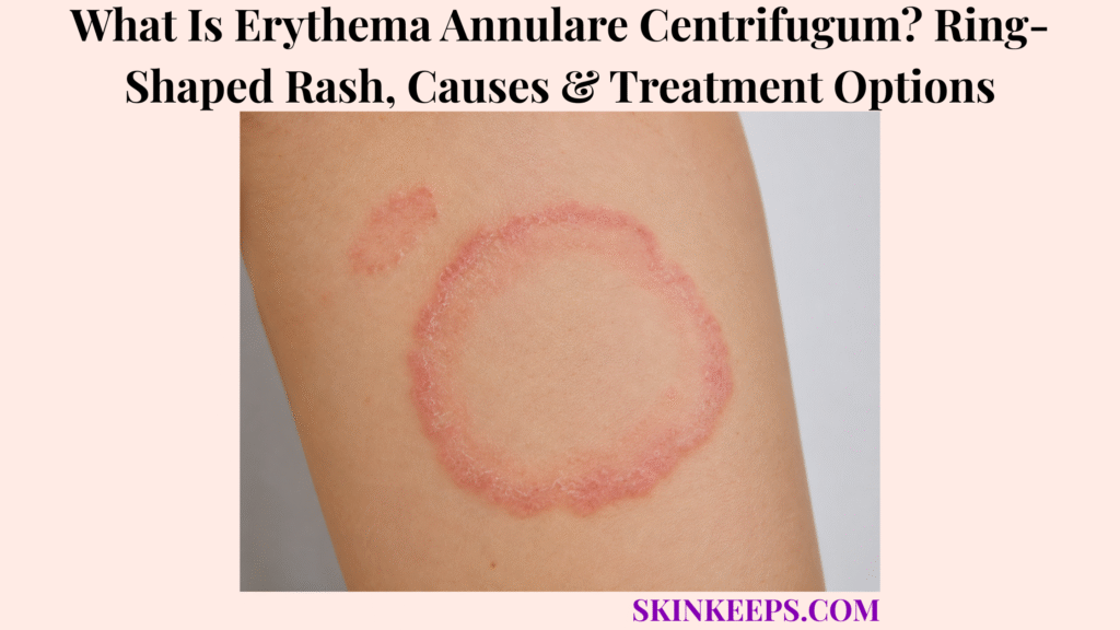 What Is Erythema Annulare Centrifugum? Ring-Shaped Rash, Causes & Treatment Options