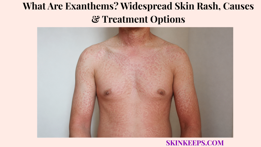 What Are Exanthems? Widespread Skin Rash, Causes & Treatment Options