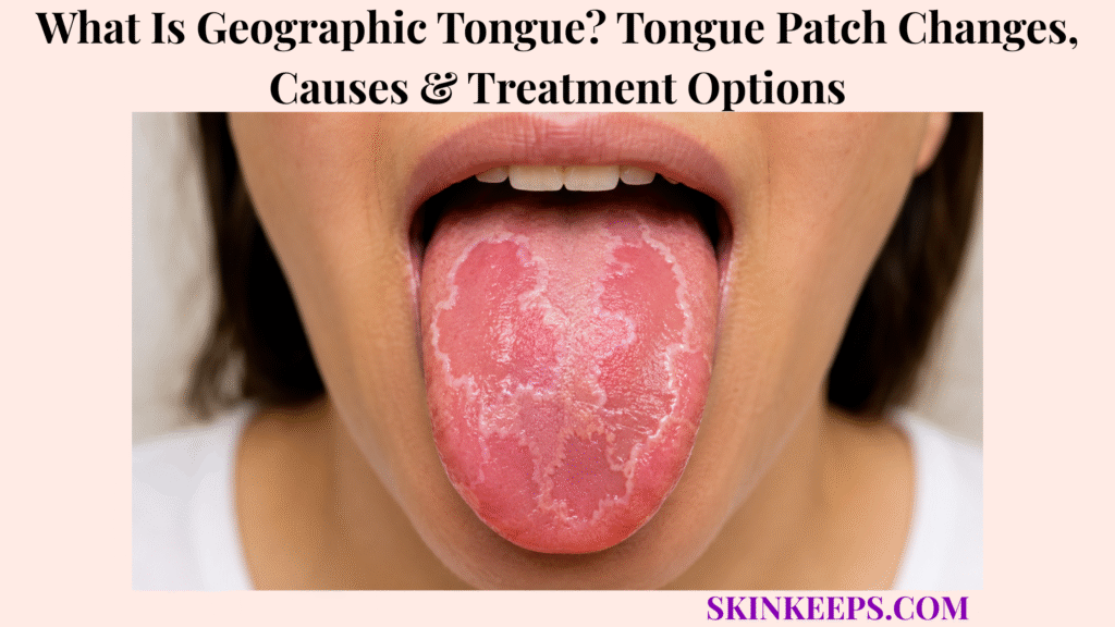 What Is Geographic Tongue? Tongue Patch Changes, Causes & Treatment Options