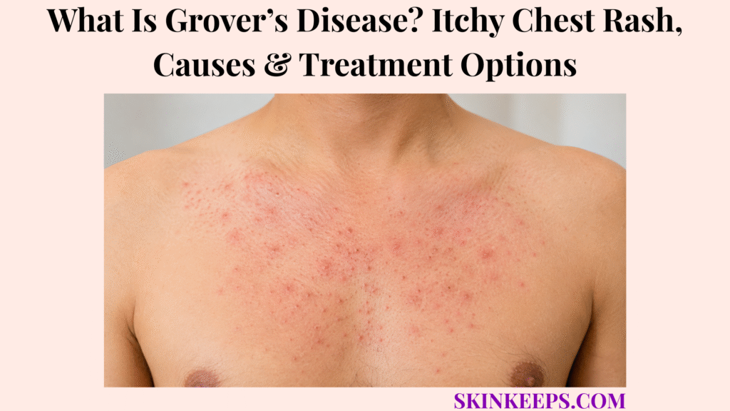 What Is Grover’s Disease? Itchy Chest Rash, Causes & Treatment Options