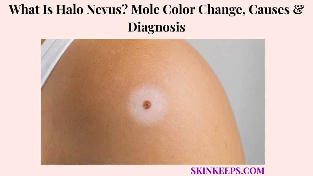 What Is Halo Nevus? Mole Color Change, Causes & Diagnosis