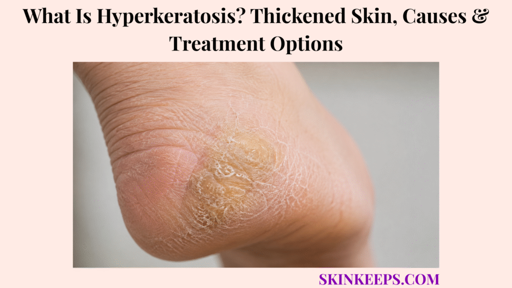 What Is Hyperkeratosis? Thickened Skin, Causes & Treatment Options