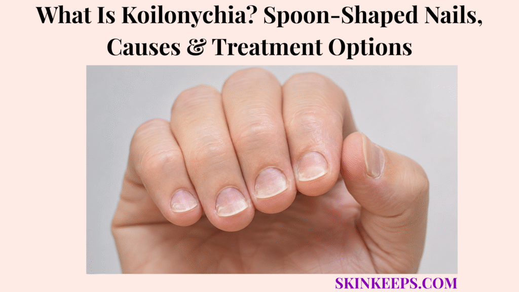 What Is Koilonychia? Spoon-Shaped Nails, Causes & Treatment Options