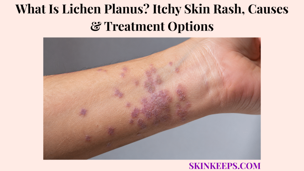 What Is Lichen Planus? Itchy Skin Rash, Causes & Treatment Options