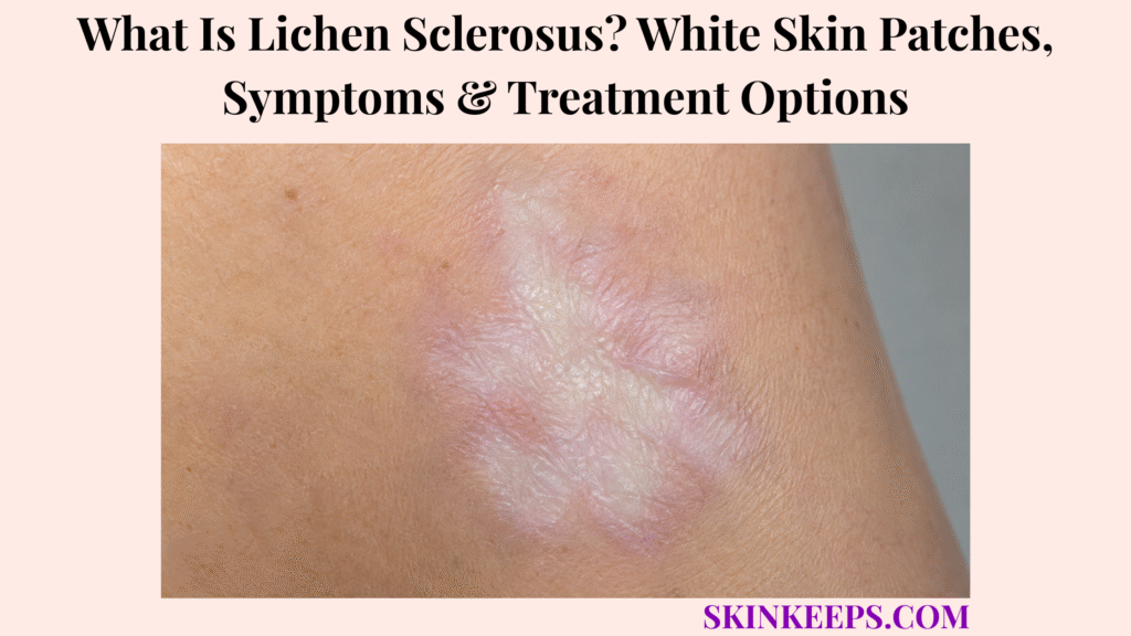 What Is Lichen Sclerosus? White Skin Patches, Symptoms & Treatment Options