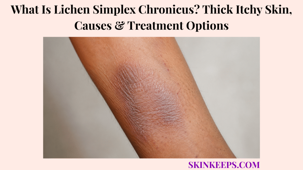 What Is Lichen Simplex Chronicus? Thick Itchy Skin, Causes & Treatment Options