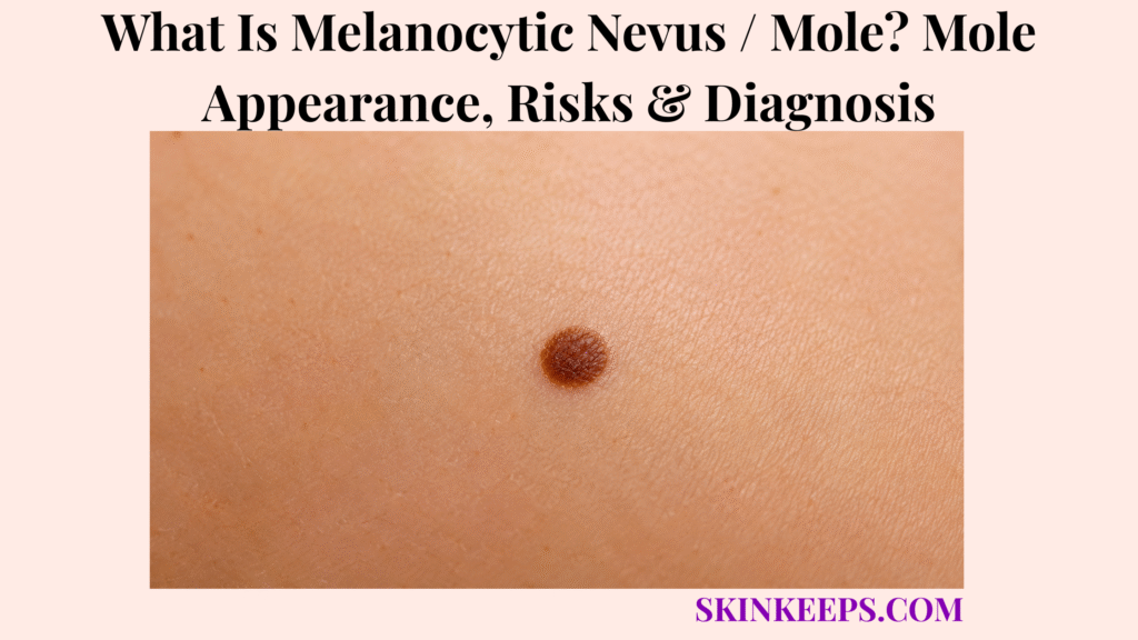 What Is Melanocytic Nevus / Mole? Mole Appearance, Risks & Diagnosis