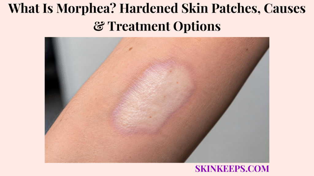 What Is Morphea? Hardened Skin Patches, Causes & Treatment Options