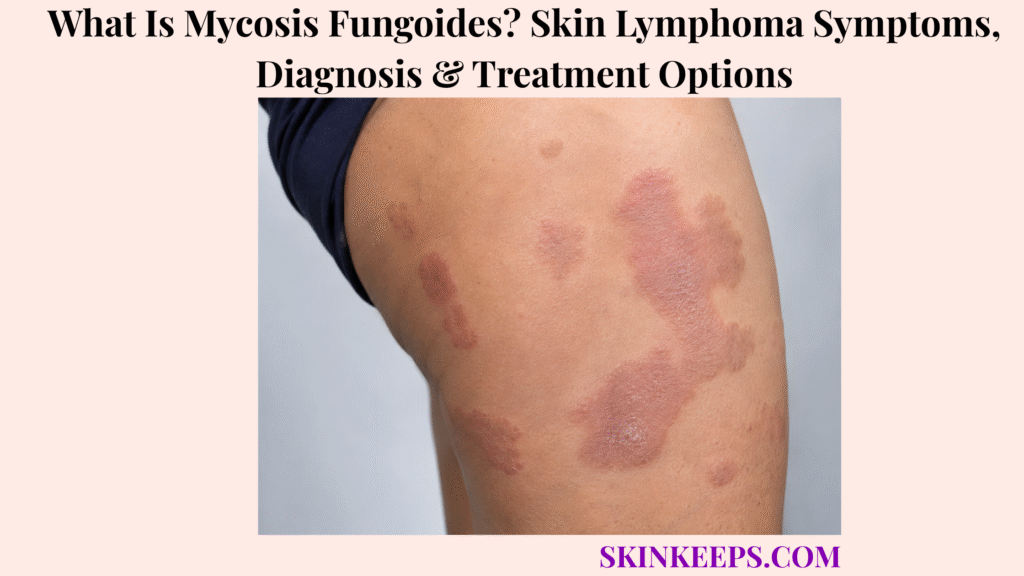 What Is Mycosis Fungoides? Skin Lymphoma Symptoms, Diagnosis & Treatment Options