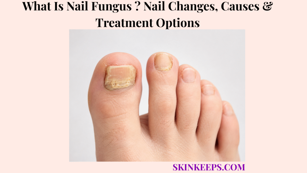 What Is Nail Fungus ? Nail Changes, Causes & Treatment Options