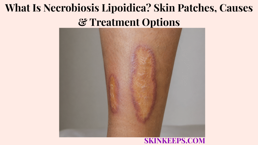 What Is Necrobiosis Lipoidica? Skin Patches, Causes & Treatment Options