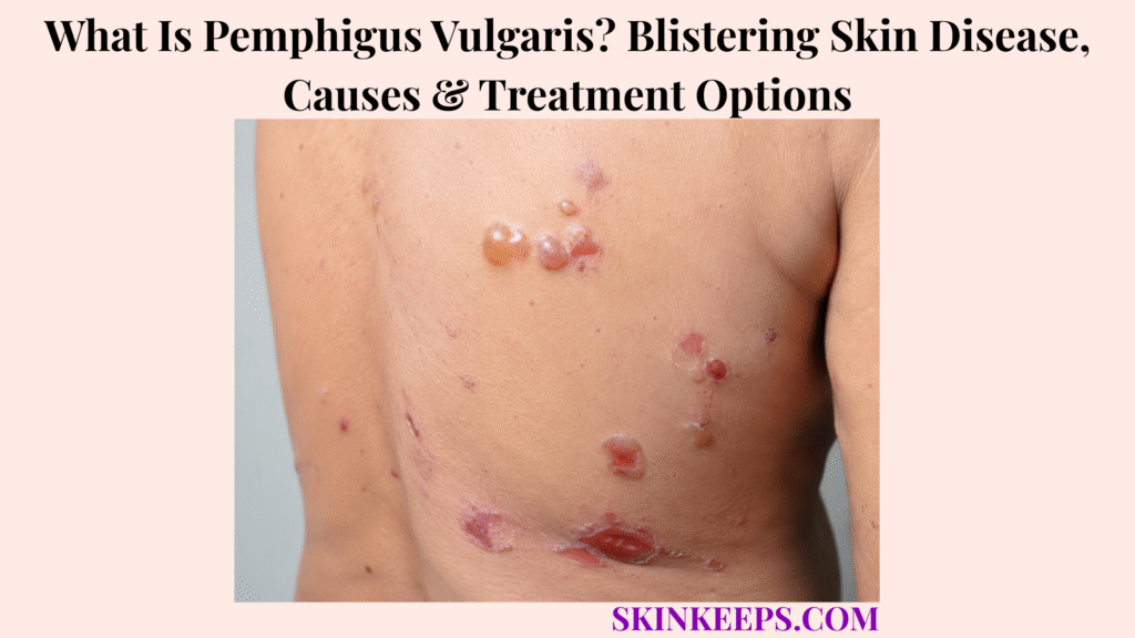 What Is Pemphigus Vulgaris? Blistering Skin Disease, Causes & Treatment Options