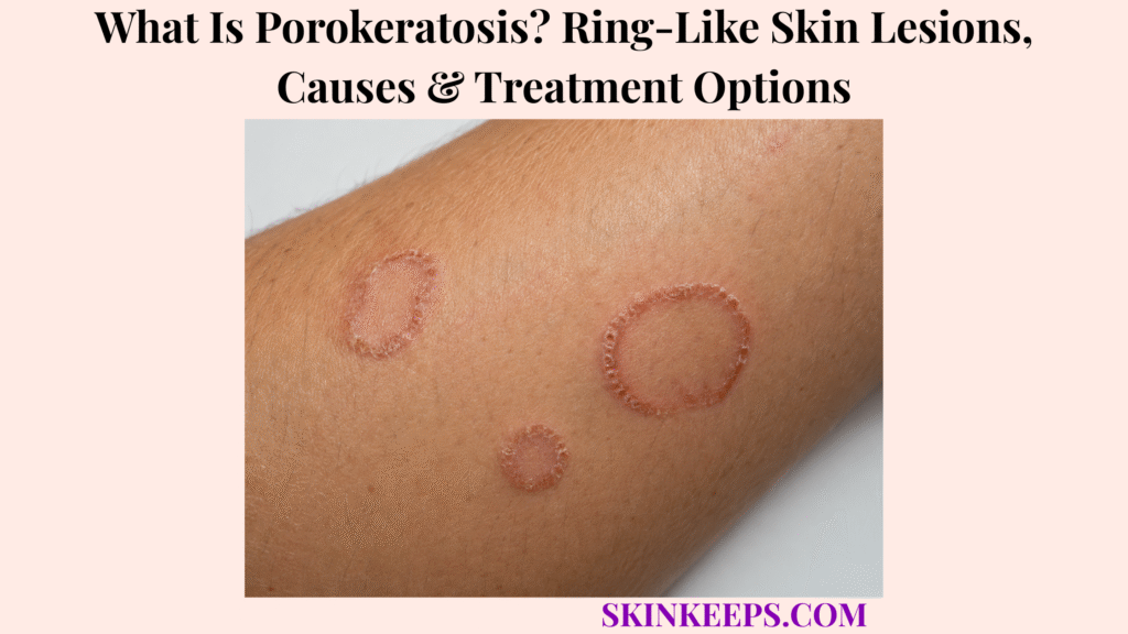 What Is Porokeratosis? Ring-Like Skin Lesions, Causes & Treatment Options
