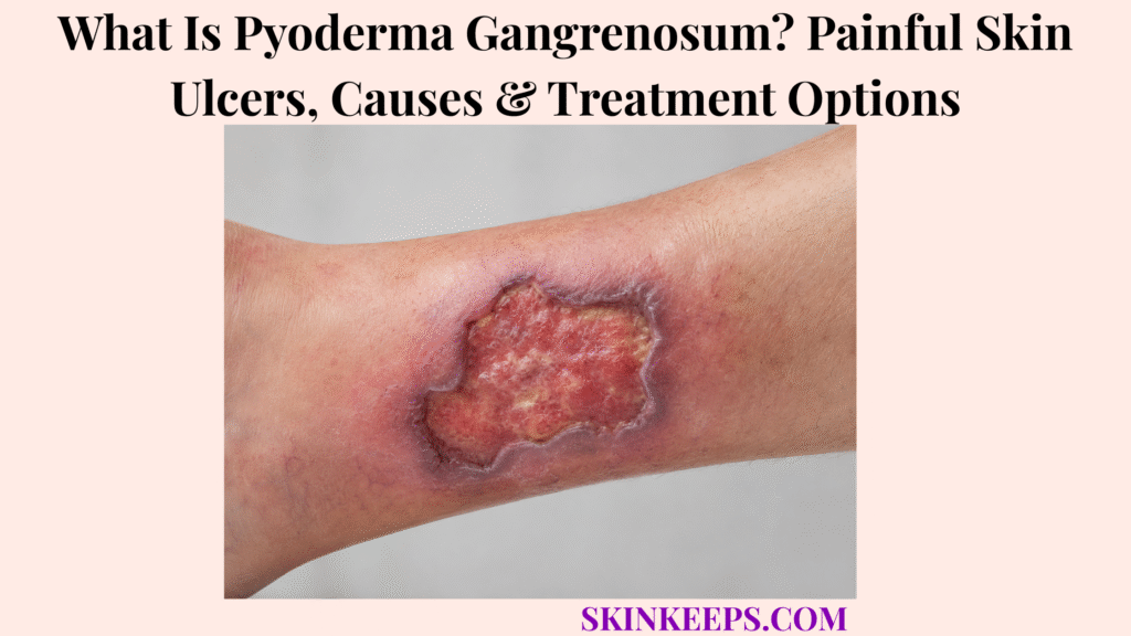 What Is Pyoderma Gangrenosum? Painful Skin Ulcers, Causes & Treatment Options