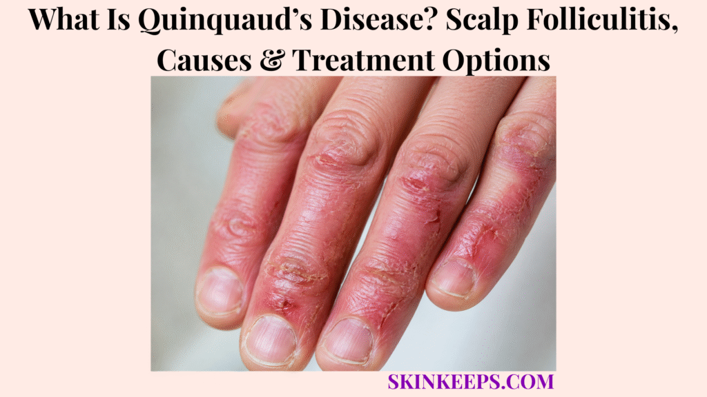 What Is Quinquaud’s Disease (Folliculitis Decalvans)? Scalp Pustules, Scarring Hair Loss & Treatment Options