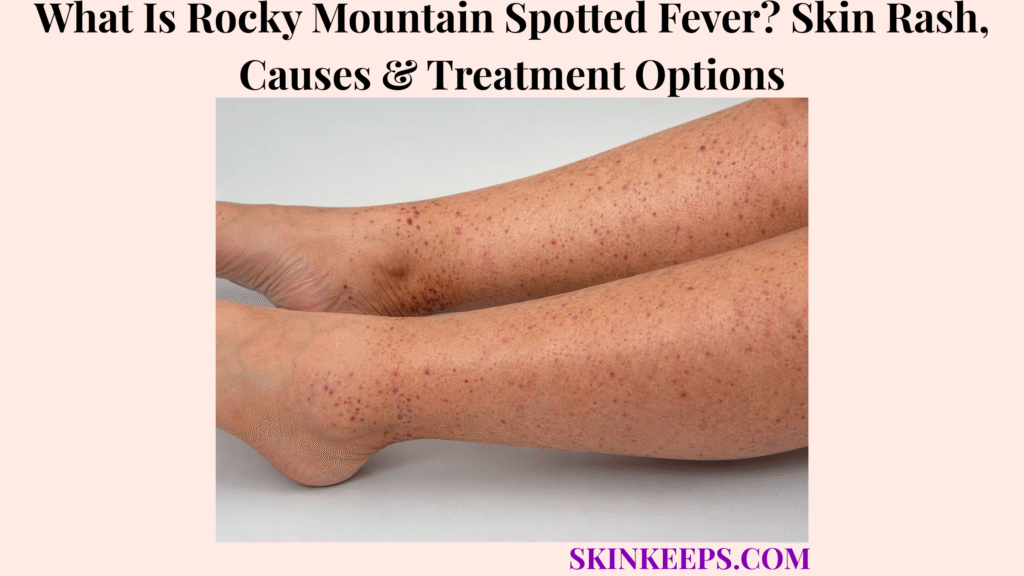 What Is Rocky Mountain Spotted Fever? Skin Rash, Causes & Treatment Options