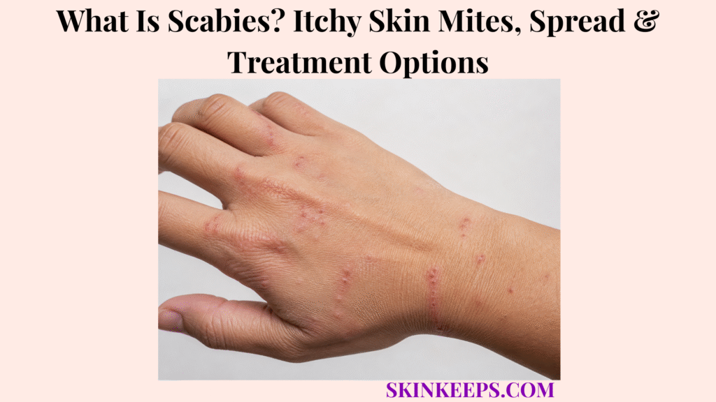 What Is Scabies? Itchy Skin Mites, Spread & Treatment Options