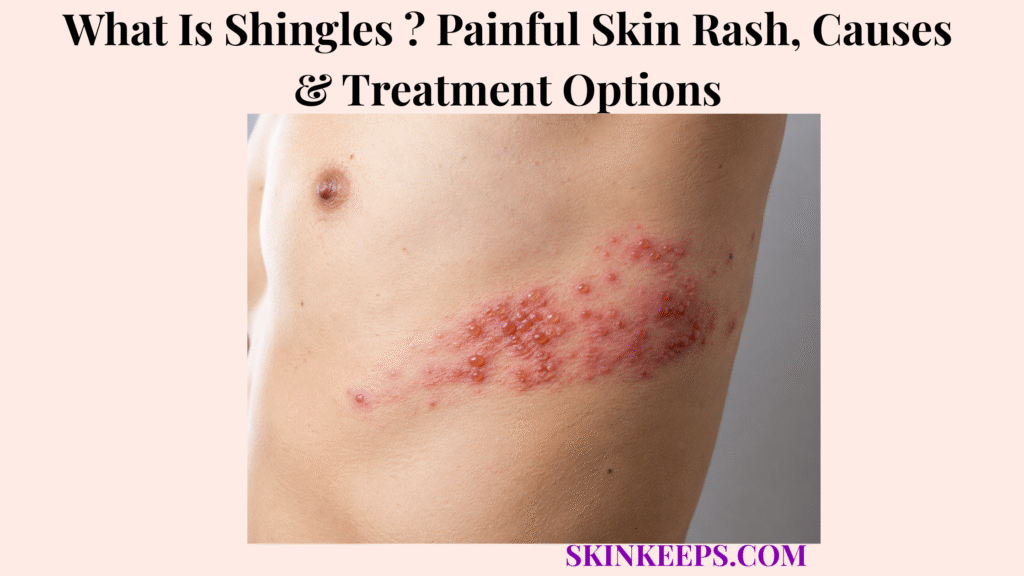 What Is Shingles? Painful Skin Rash, Causes & Treatment Options