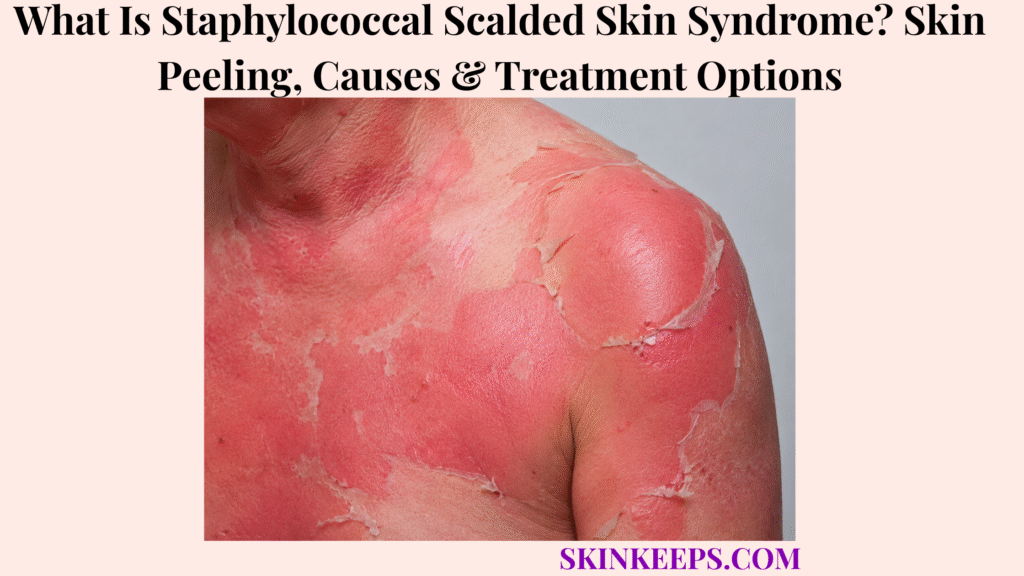 What Is Staphylococcal Scalded Skin Syndrome? Skin Peeling, Causes & Treatment Options