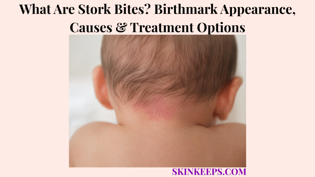 What Are Stork Bites? Birthmark Appearance, Causes & Treatment Options