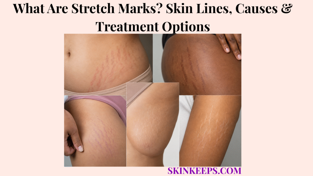 What Are Stretch Marks? Skin Lines, Causes & Treatment Options