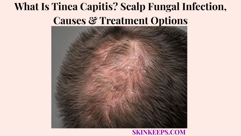 What Is Tinea Capitis? Scalp Fungal Infection, Causes & Treatment Options