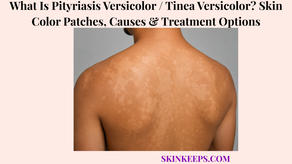 What Is Pityriasis Versicolor / Tinea Versicolor? Skin Color Patches, Causes & Treatment Options