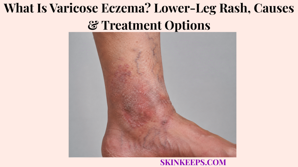 What Is Varicose Eczema? Lower-Leg Rash, Causes & Treatment Options