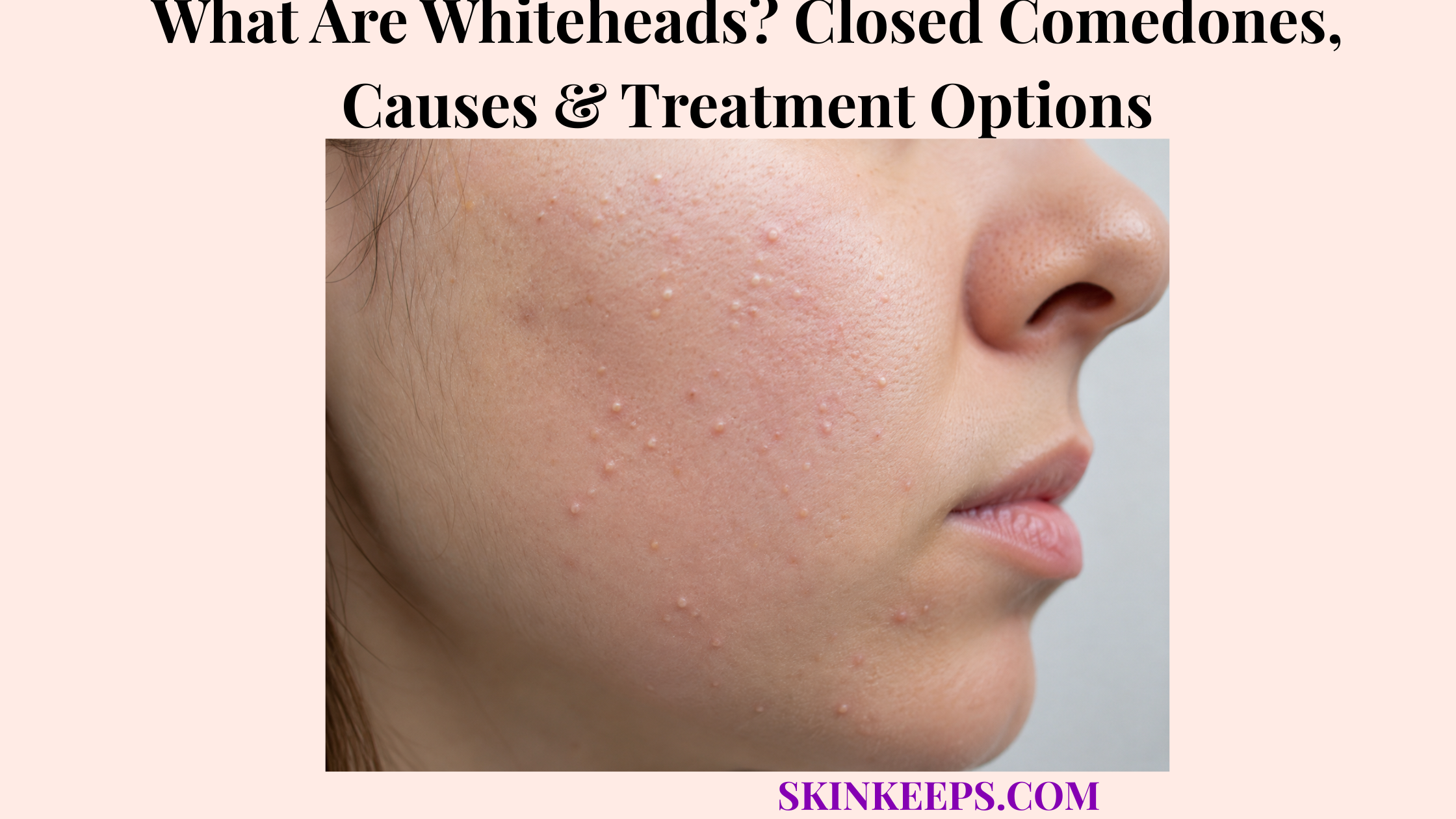 What Are Whiteheads? Closed Comedones, Causes & Treatment Options