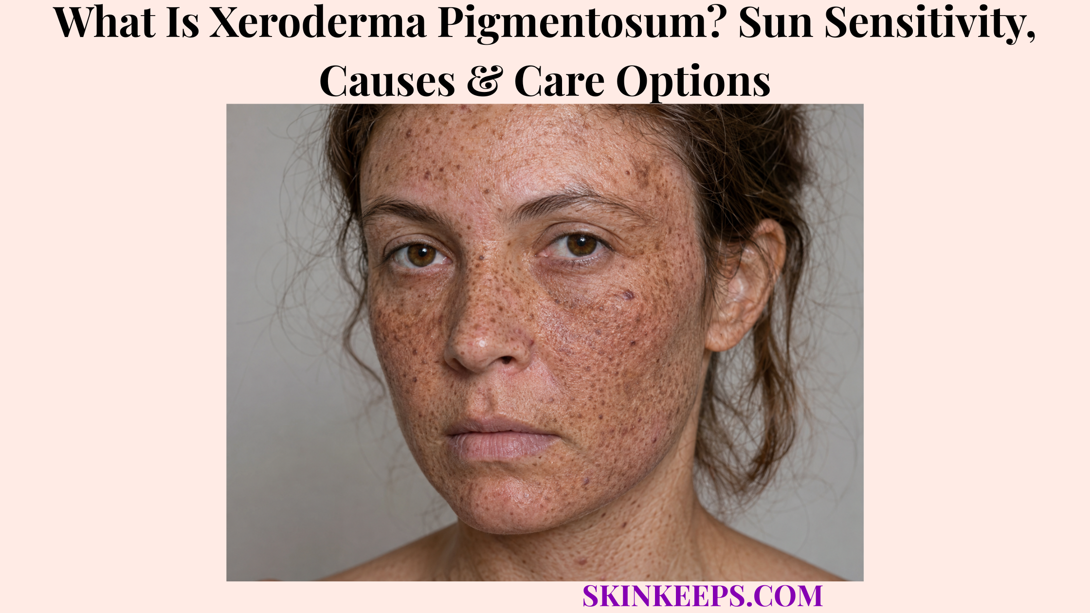 What Is Xeroderma Pigmentosum? Sun Sensitivity, Causes & Care Options