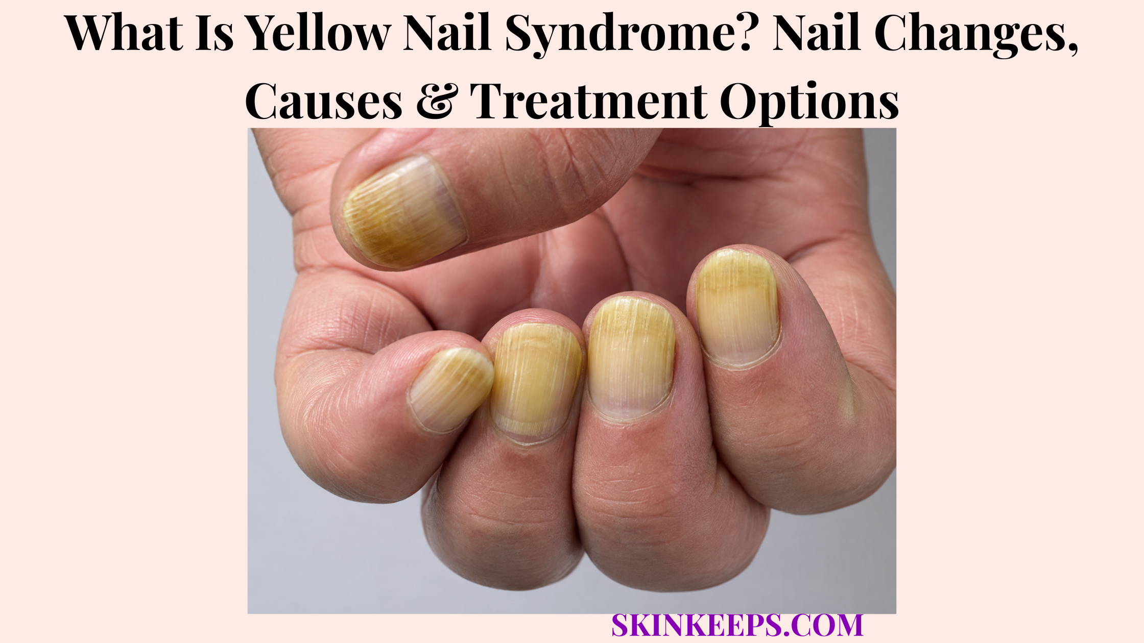 What Is Yellow Nail Syndrome? Nail Changes, Causes & Treatment Options